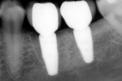 25. dental implants crowns xray oral surgeon best dentist bethesda