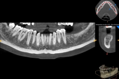 3. cone beam ct scan for implants oral surgeon best dentist bethesda