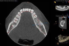 4. cbct for implants oral surgeon best dentist bethesda