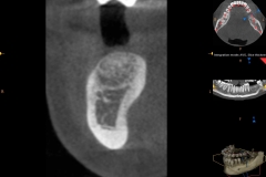 5. cone beam ct scan for implant teeth oral surgeon best dentist bethesda