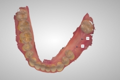6. optical digital scan for implants oral surgeon best dentist bethesda