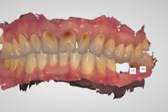 8. digital impression for implants oral surgeon best dentist bethesda