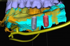 9. digital implant dentistry oral surgeon best dentist bethesda
