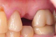 1.-dental-implant-missing-tooth-digital-dentistry-best-dentist-bethedsa-washington-dc-virginia-kazemi-oral-surgery
