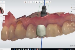 2.-dental-implant-missing-tooth-digital-dentistry-best-dentist-bethedsa-washington-dc-virginia-kazemi-oral-surgery-trios