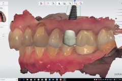 3.-dental-implant-missing-tooth-digital-dentistry-best-dentist-bethedsa-washington-dc-virginia-kazemi-oral-surgery-trios