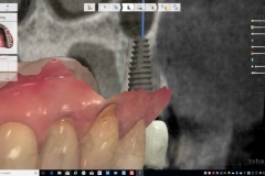 4.-dental-implant-missing-tooth-digital-dentistry-best-dentist-bethedsa-washington-dc-virginia-kazemi-oral-surgery-trios