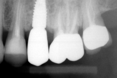 5.-dental-implant-missing-tooth-digital-dentistry-best-dentist-bethedsa-washington-dc-virginia-kazemi-oral-surgery-implant-X-ray