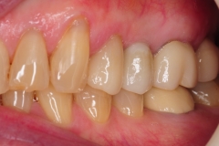 6.-dental-implant-missing-tooth-digital-dentistry-best-dentist-bethedsa-washington-dc-virginia-kazemi-oral-surgery-aesthetic-dentistry