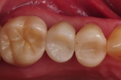 7.-dental-implant-missing-tooth-digital-dentistry-best-dentist-bethedsa-washington-dc-virginia-kazemi-oral-surgery-aesthetic-dentistry