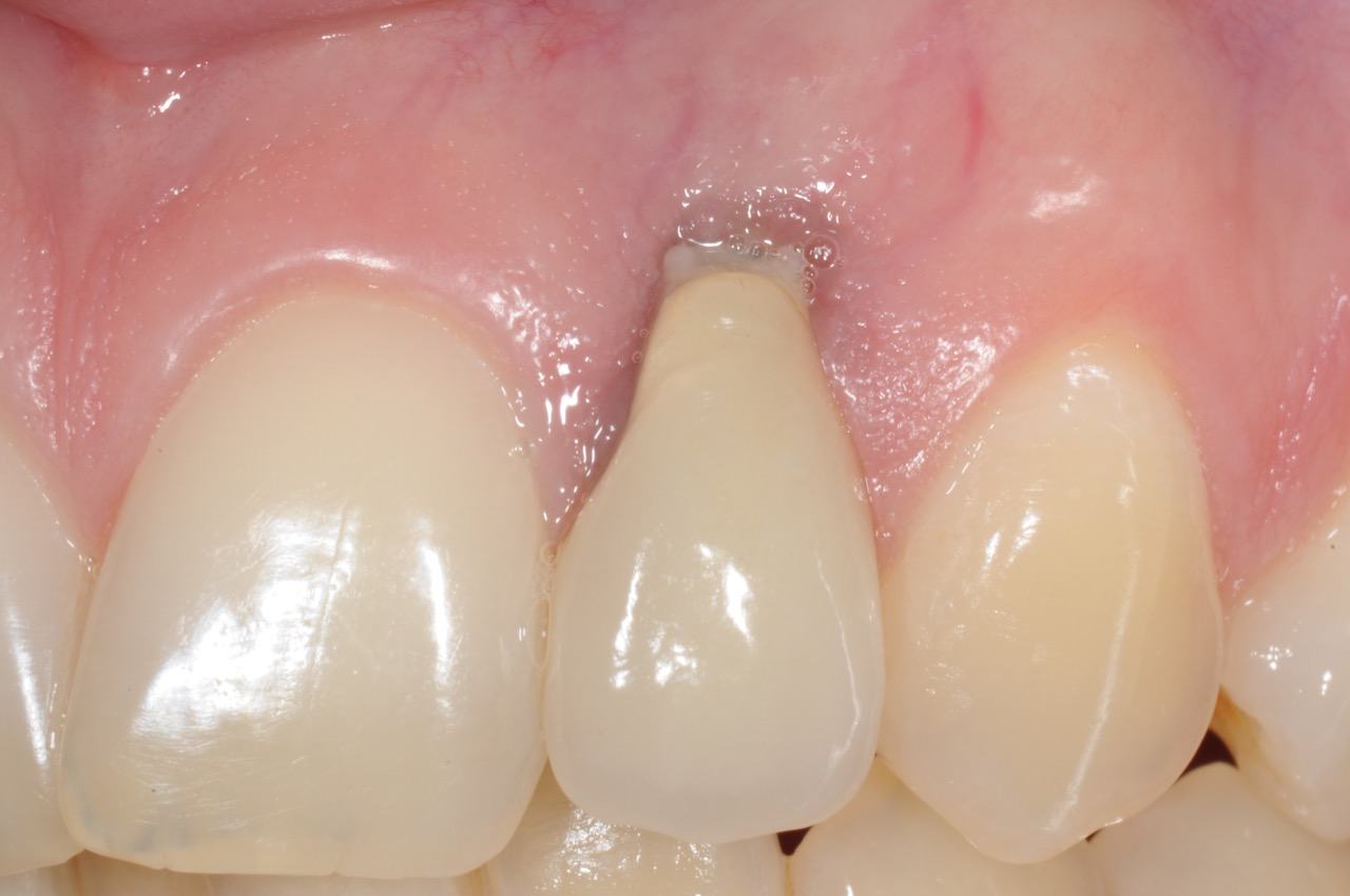 dental-implant-gum-bone-recession-complication-bone-graft-kazemi-oral-surgery-bethesda-dentist-1