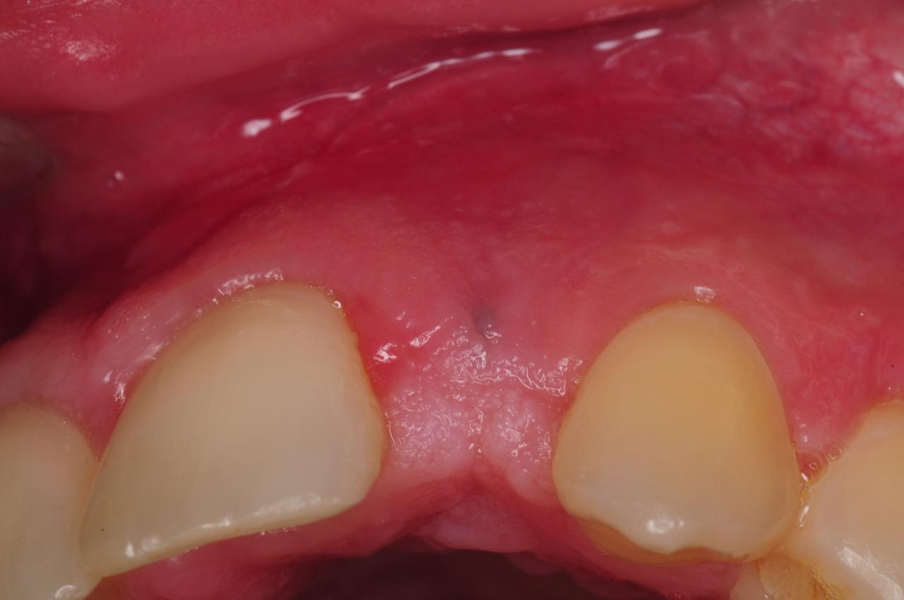 dental-implant-gum-bone-recession-complication-bone-graft-kazemi-oral-surgery-bethesda-dentist-13