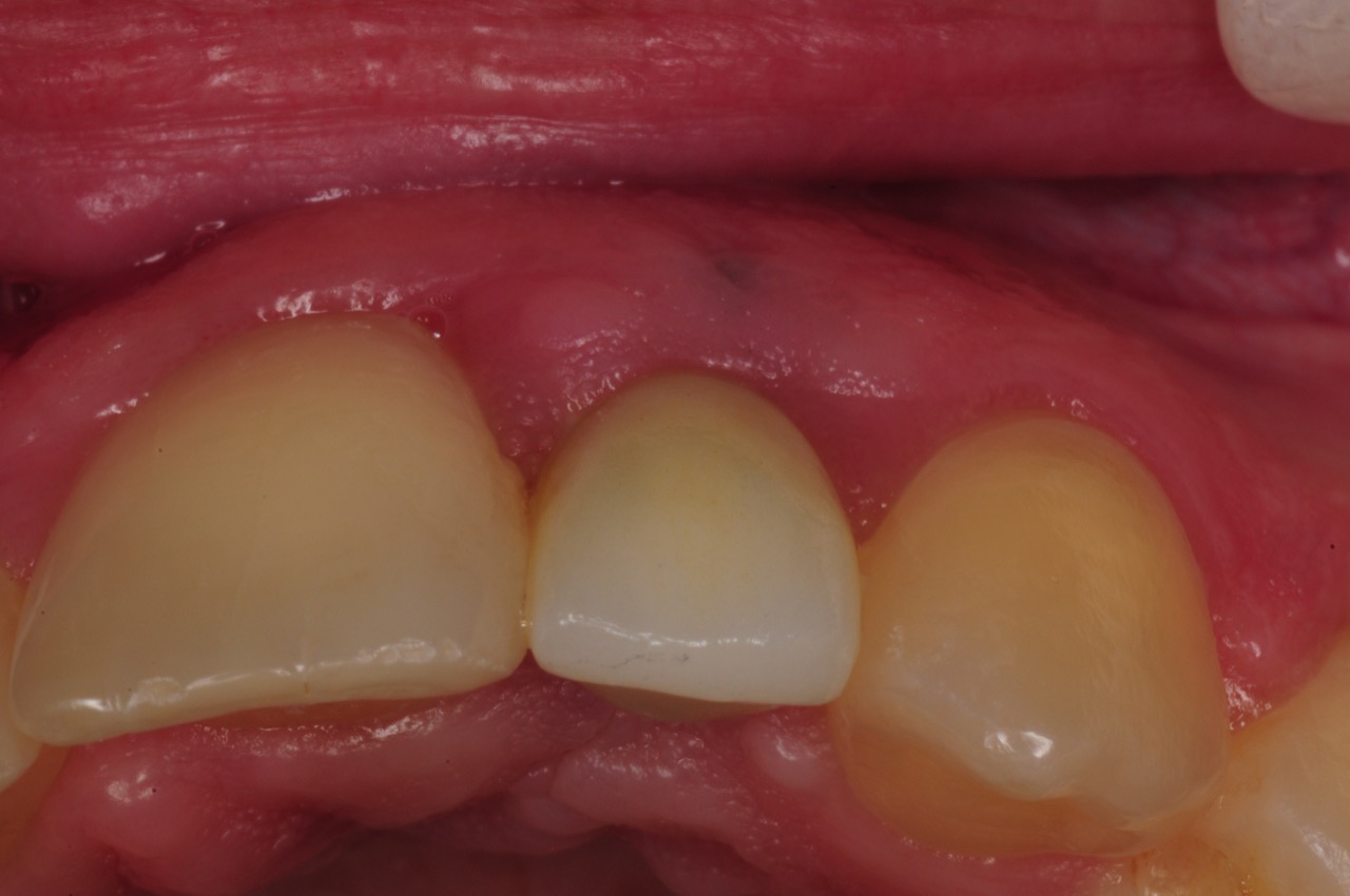 dental-implant-gum-bone-recession-complication-bone-graft-kazemi-oral-surgery-bethesda-dentist-18