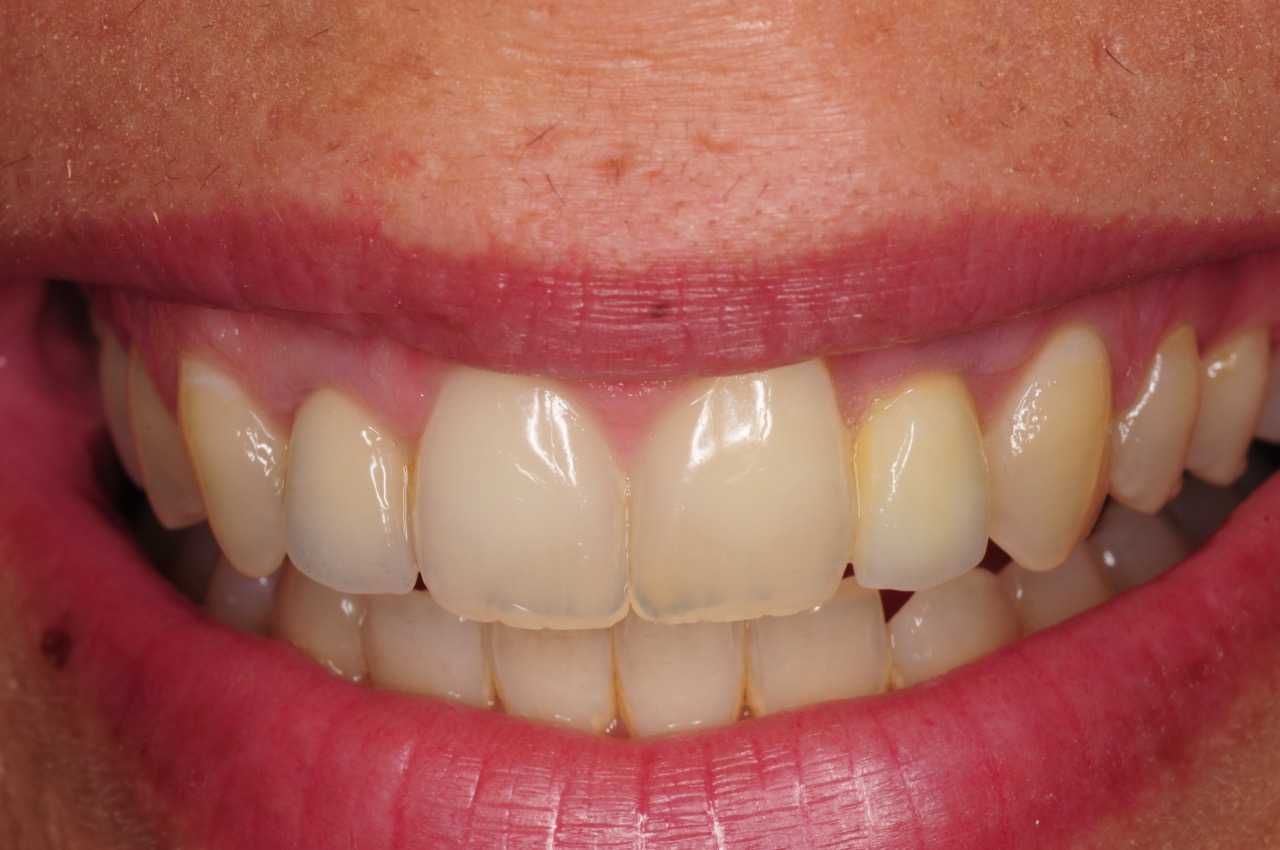 dental-implant-gum-bone-recession-complication-bone-graft-kazemi-oral-surgery-bethesda-dentist-19