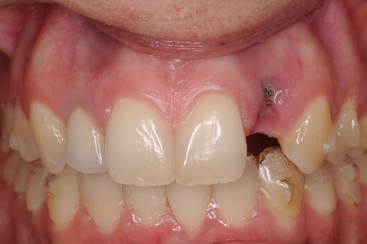 dental-implant-gum-bone-recession-complication-bone-graft-kazemi-oral-surgery-bethesda-dentist-3