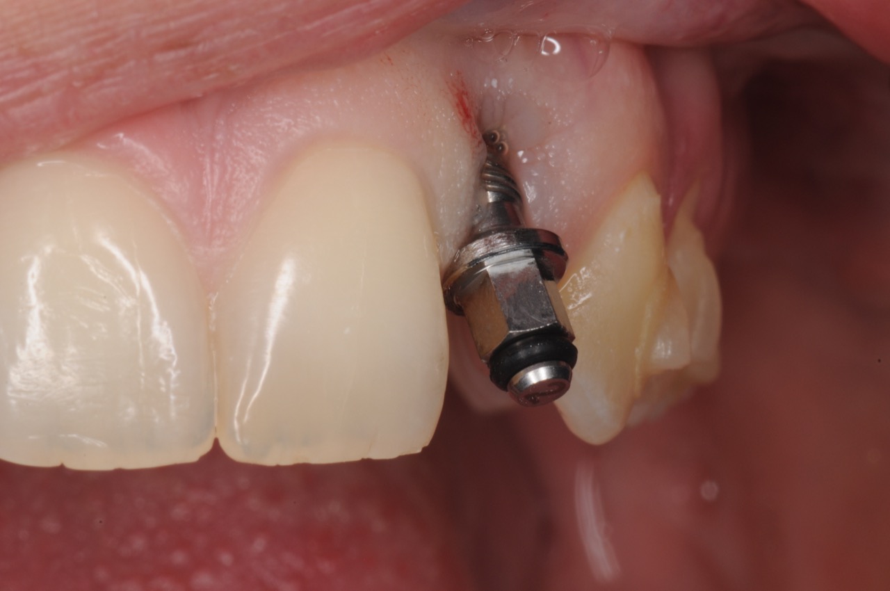 dental-implant-gum-bone-recession-complication-bone-graft-kazemi-oral-surgery-bethesda-dentist-6