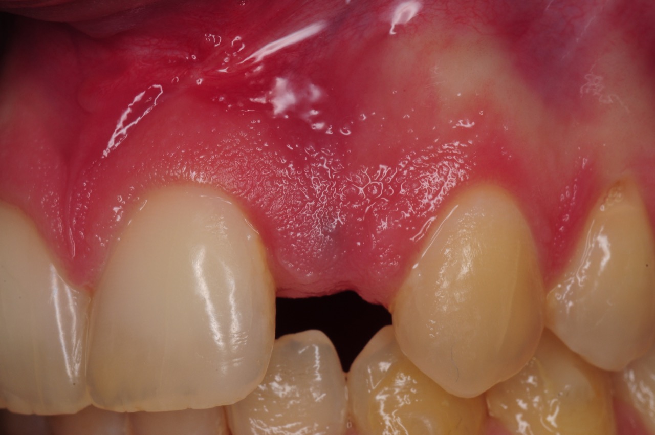 dental-implant-gum-bone-recession-complication-bone-graft-kazemi-oral-surgery-bethesda-dentist-7