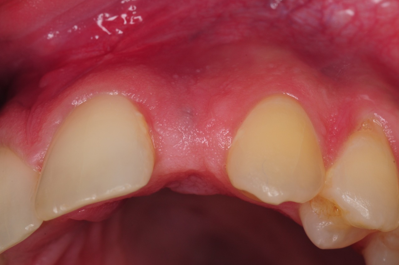 dental-implant-gum-bone-recession-complication-bone-graft-kazemi-oral-surgery-bethesda-dentist-8