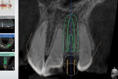 dental-implant-gum-bone-recession-complication-bone-graft-kazemi-oral-surgery-bethesda-dentist-10