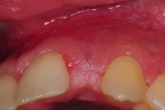 dental-implant-gum-bone-recession-complication-bone-graft-kazemi-oral-surgery-bethesda-dentist-13