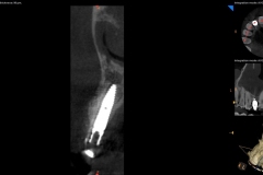 dental-implant-gum-bone-recession-complication-bone-graft-kazemi-oral-surgery-bethesda-dentist-15