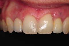 dental-implant-gum-bone-recession-complication-bone-graft-kazemi-oral-surgery-bethesda-dentist-16