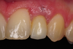 dental-implant-gum-bone-recession-complication-bone-graft-kazemi-oral-surgery-bethesda-dentist-17