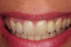 dental-implant-gum-bone-recession-complication-bone-graft-kazemi-oral-surgery-bethesda-dentist-19