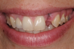 dental-implant-gum-bone-recession-complication-bone-graft-kazemi-oral-surgery-bethesda-dentist-2