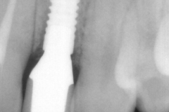 dental-implant-gum-bone-recession-complication-bone-graft-kazemi-oral-surgery-bethesda-dentist-20