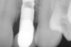 dental-implant-gum-bone-recession-complication-bone-graft-kazemi-oral-surgery-bethesda-dentist-4