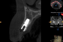 dental-implant-gum-bone-recession-complication-bone-graft-kazemi-oral-surgery-bethesda-dentist-5