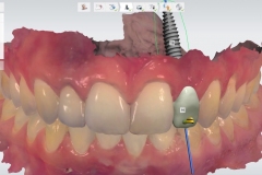 dental-implant-gum-bone-recession-complication-bone-graft-kazemi-oral-surgery-bethesda-dentist-9