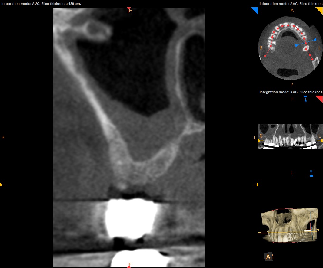 2.-sinus-lift-bone-graft-dental-implants-kazemi-oral-surgery