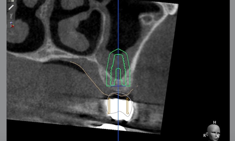 3.-sinus-lift-bone-graft-dental-implants-kazemi-oral-surgery