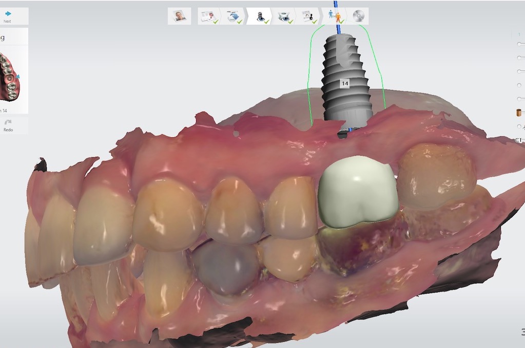 4.-sinus-lift-bone-graft-dental-implants-digital-planning-kazemi-oral-surgery