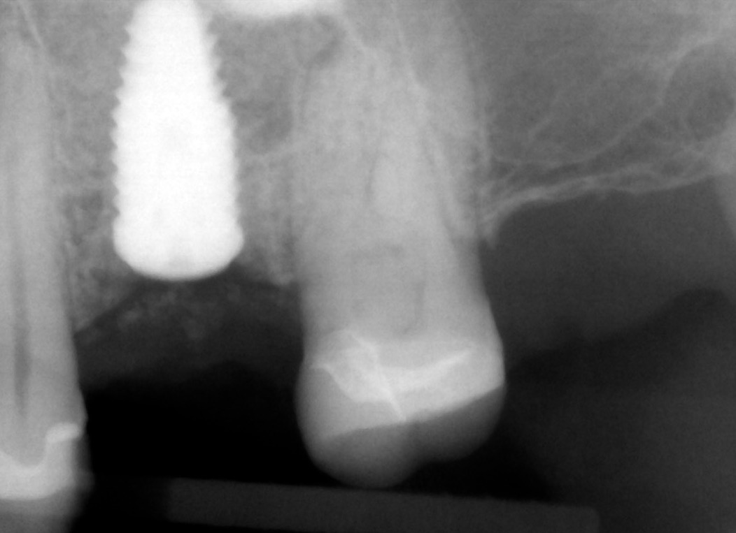6.-sinus-lift-bone-graft-dental-implants-kazemi-oral-surgery