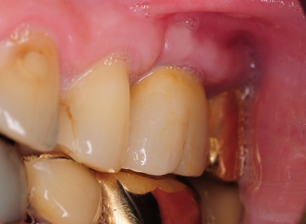 7.-sinus-lift-bone-graft-dental-implants-kazemi-oral-surgery