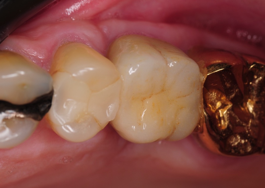 8.-sinus-lift-bone-graft-dental-implants-kazemi-oral-surgery