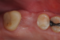 1.-sinus-lift-bone-graft-dental-implants-kazemi-oral-surgery