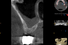 2.-sinus-lift-bone-graft-dental-implants-kazemi-oral-surgery