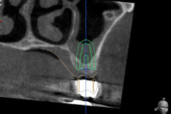 3.-sinus-lift-bone-graft-dental-implants-kazemi-oral-surgery