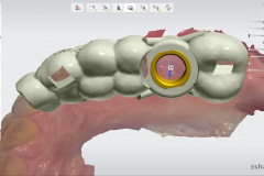 5.-sinus-lift-bone-graft-dental-implants-digital-surgical-guide-kazemi-oral-surgery