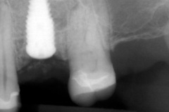 6.-sinus-lift-bone-graft-dental-implants-kazemi-oral-surgery