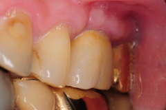7.-sinus-lift-bone-graft-dental-implants-kazemi-oral-surgery