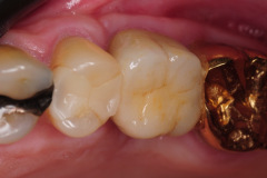 8.-sinus-lift-bone-graft-dental-implants-kazemi-oral-surgery