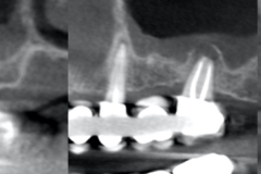sinus-perforation-after-tooth-extraction-foundation-bone-graft-PRF-kazemi-oral-surgery-01