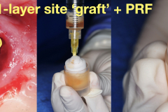 sinus-perforation-after-tooth-extraction-foundation-bone-graft-PRF-kazemi-oral-surgery-02