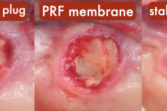 sinus-perforation-after-tooth-extraction-foundation-bone-graft-PRF-kazemi-oral-surgery-03