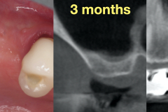 sinus-perforation-after-tooth-extraction-foundation-bone-graft-PRF-kazemi-oral-surgery-04